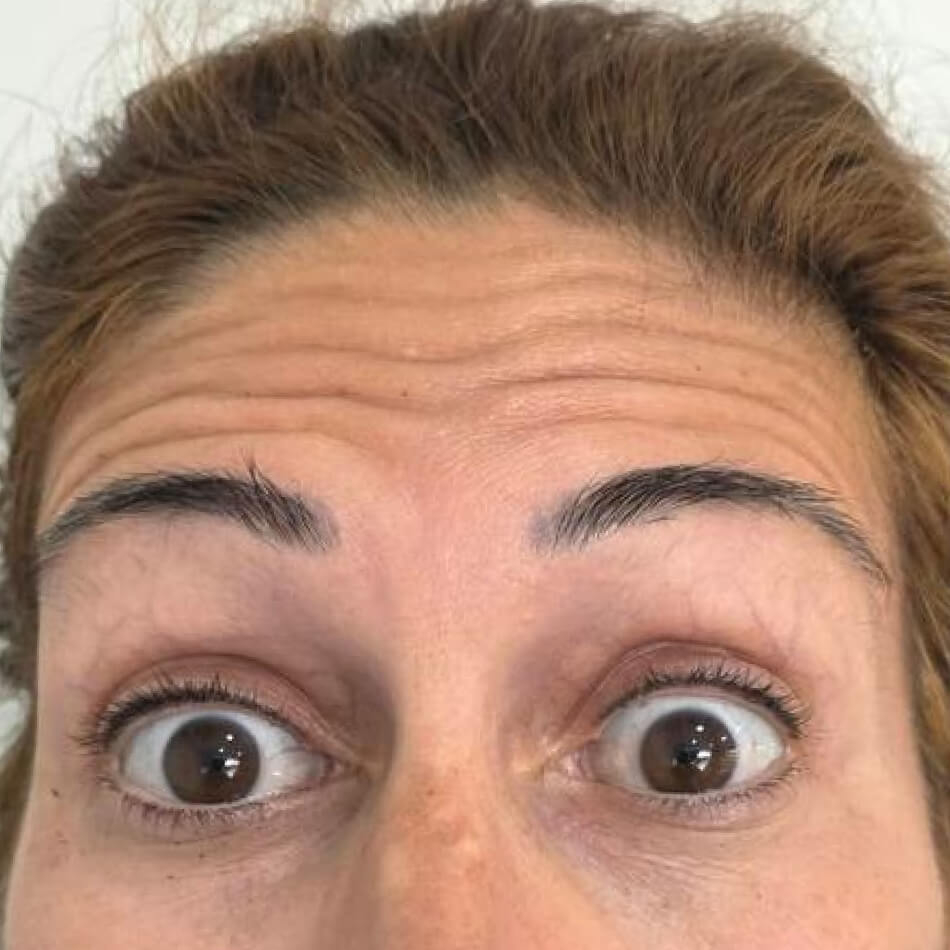 Botox-Antes
