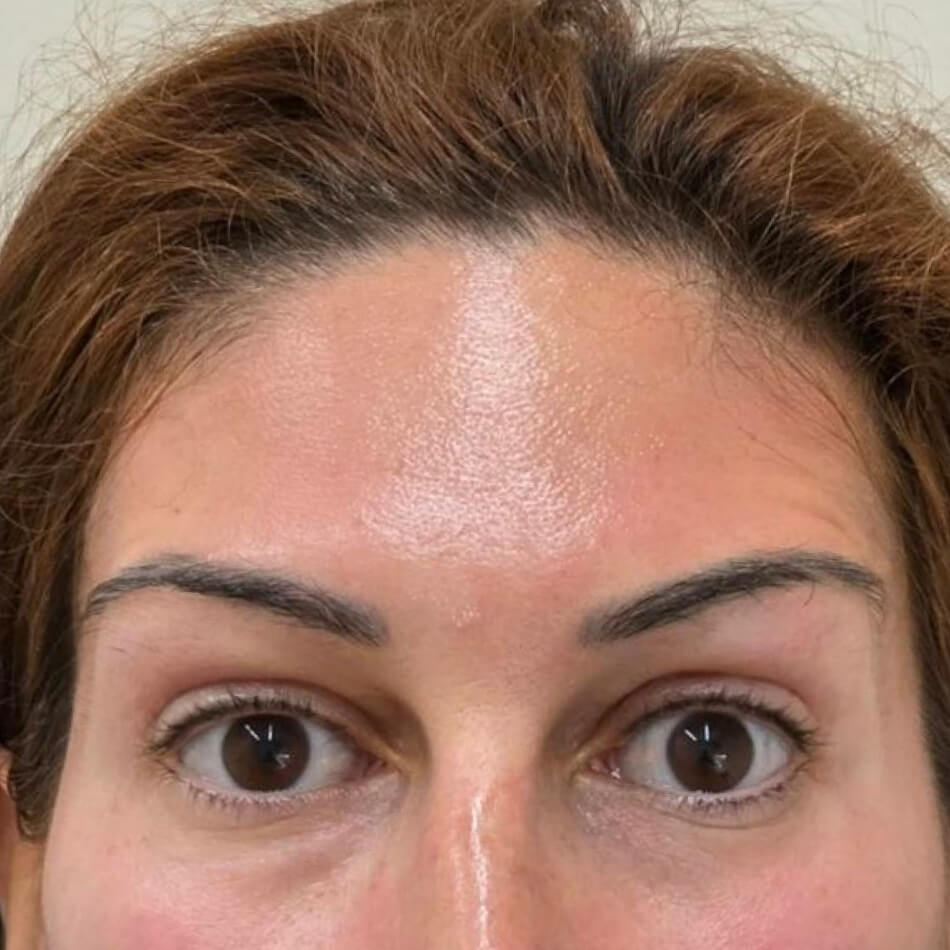 Botox-Depois