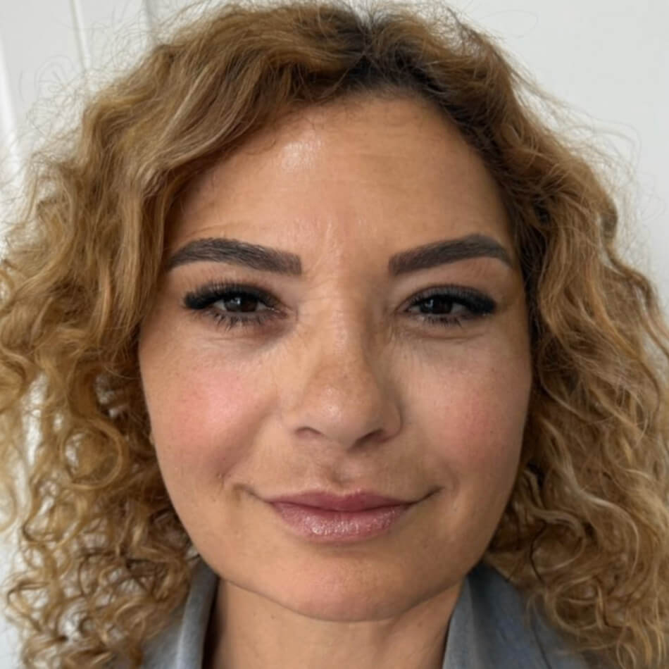 Facelifting Depois