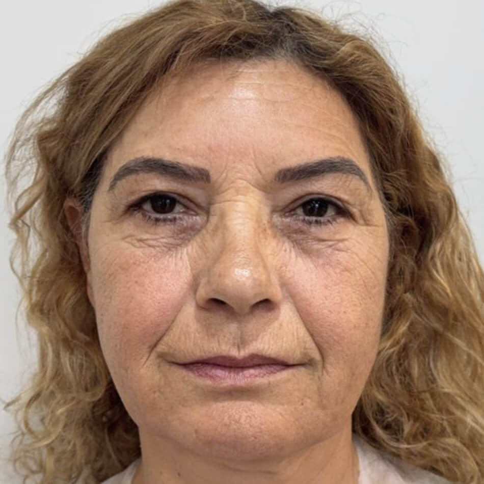 Facelifting Antes