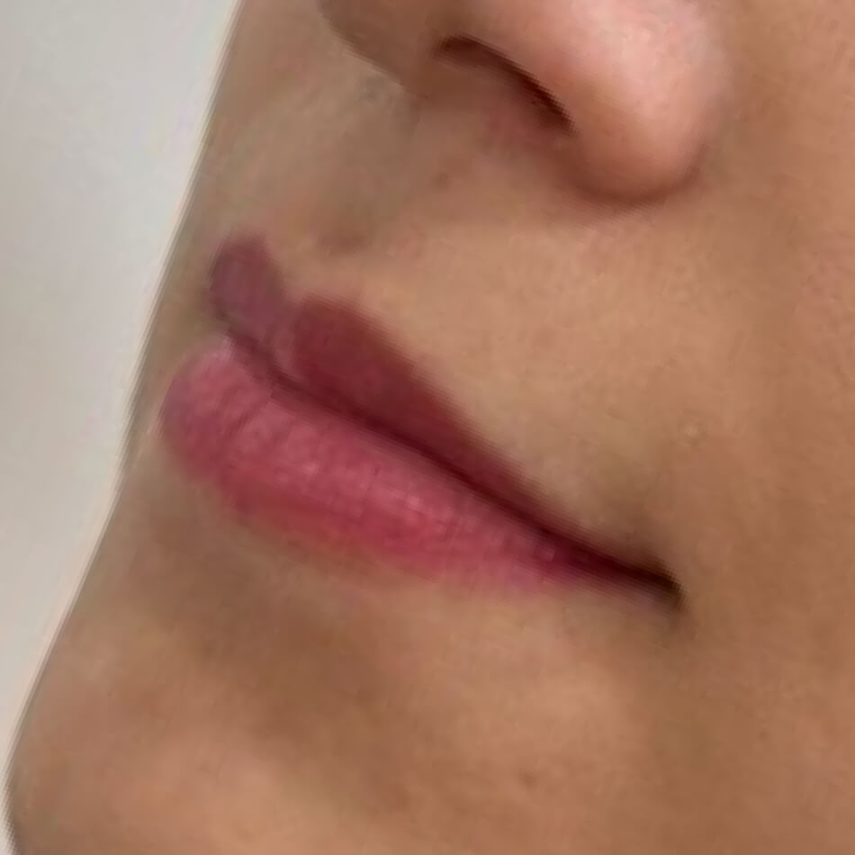 Preenchimento-Antes